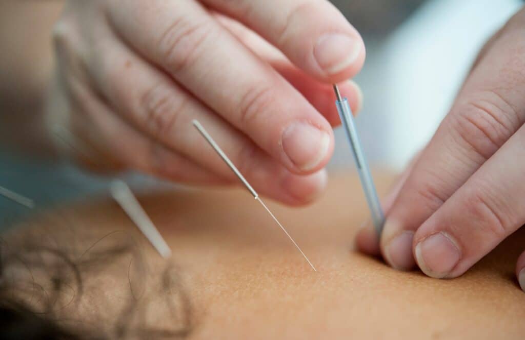 Acupuncture for Cravings